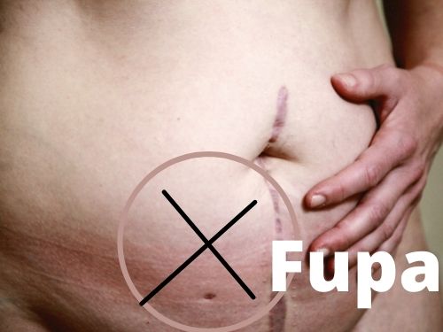 how to get rid of a fupa without surgery ( Fupa fat loss)