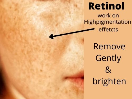 How does work Retinol for highperpigmentation